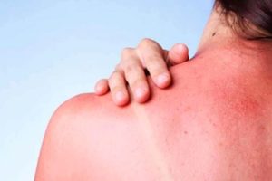 Llama IMSS Nayarit a prevenirquemaduras solares en temporada de calor.