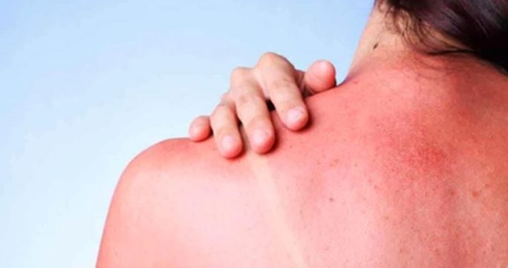 Llama IMSS Nayarit a prevenirquemaduras solares en temporada de calor.